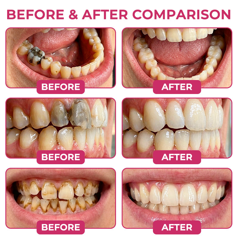 DenPerm Cavity-Repair Natural Enamel Filling Gel-JR-L7