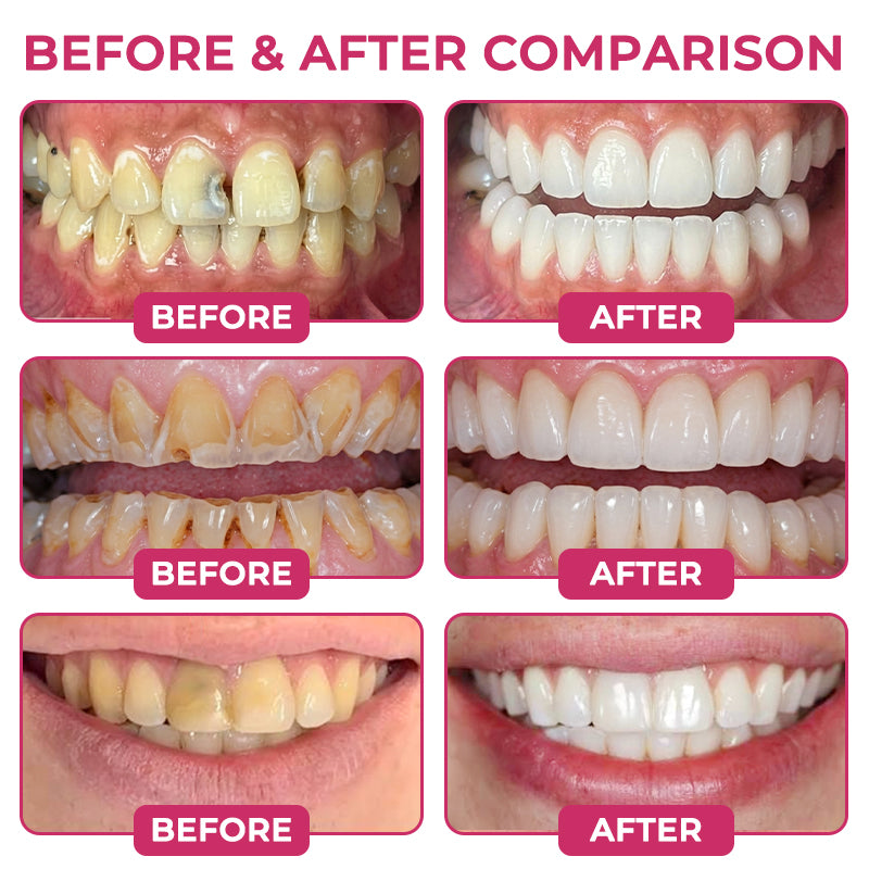 DenPerm Cavity-Repair Natural Enamel Filling Gel-JR-L7